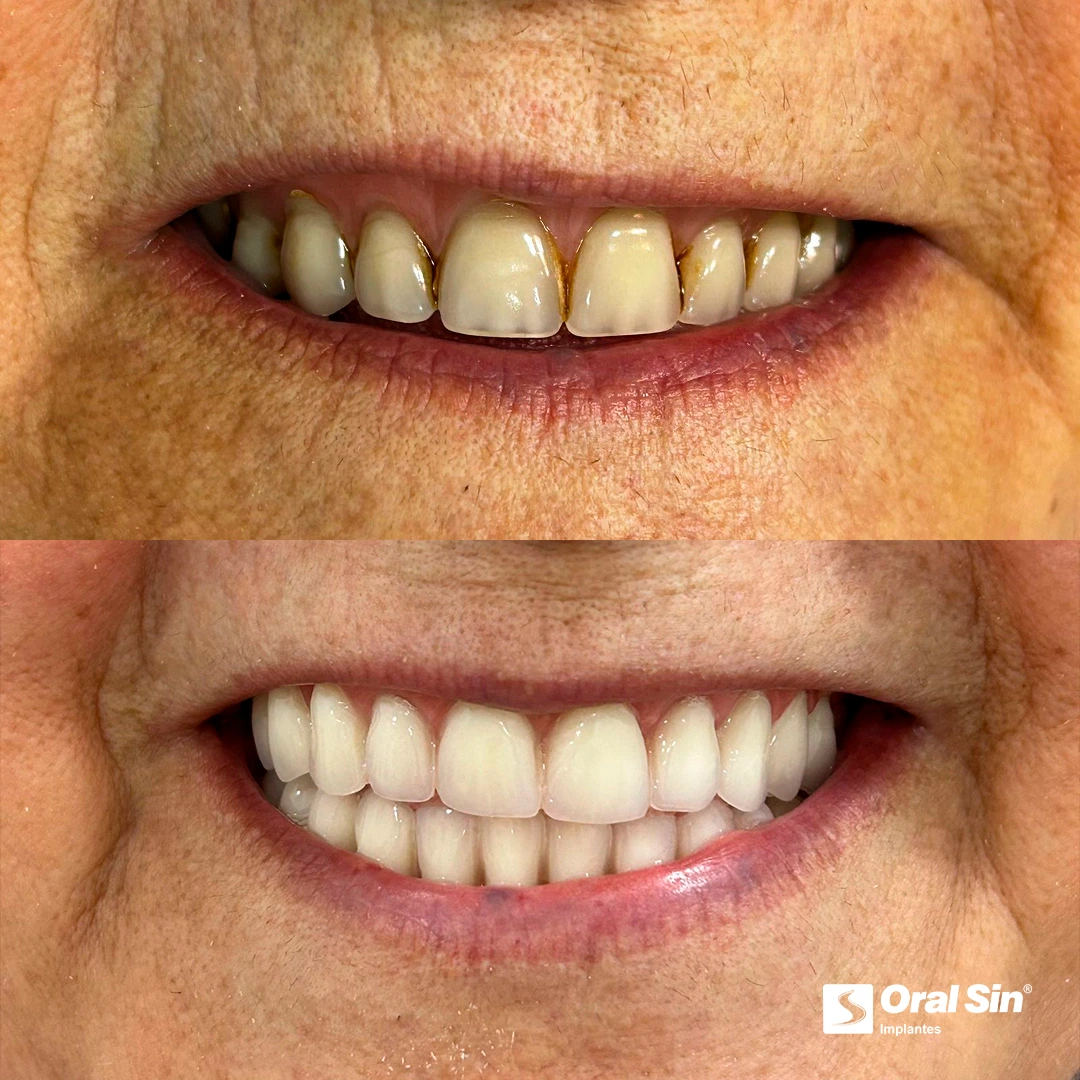 Paciente real — antes e depois 2